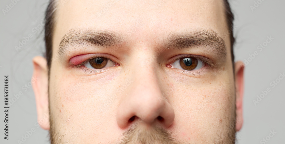 Naklejka premium Swollen red eyelid close-up, eye inflammation or stye, medical condition