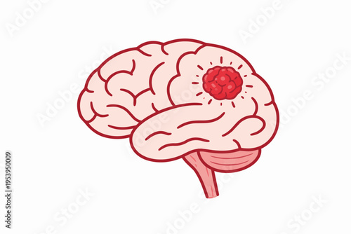 Illustration of a brain with a red tumor growing inside, symbolizing illness or disease