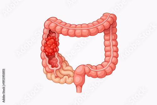 Illustration of a colon with a large tumor growth on the intestinal wall