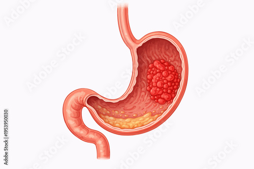 Illustration of a stomach with a large tumor growing inside its lining