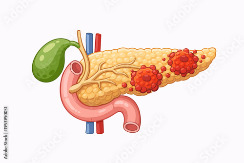 Illustration of the pancreas and gallbladder showing cancerous tumors growing on the organ