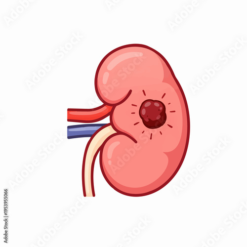Schilderij op canvas Cartoon illustration of a kidney with a tumor, showing blood vessels and ureter