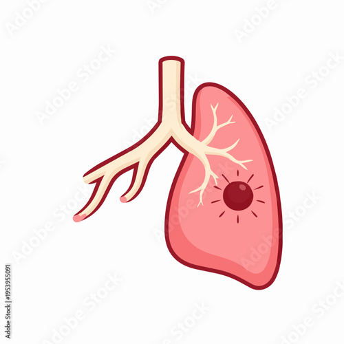 Illustration of a diseased lung with a dark red spot representing a tumor or infection