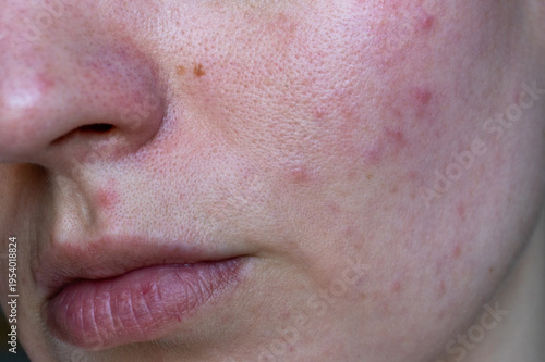 Fotografie Close up of female facial skin showing acne, redness and visible pores