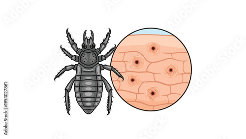 Human louse parasite shown next to a microscopic skin view with visible bite marks and inflamed circular puncture wounds.