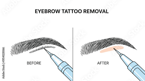 Cosmetic procedure for eyebrow tattoo removal shown in before and after comparison using professional laser treatment technology.