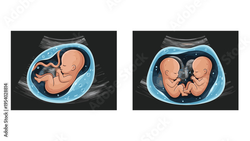 Medical diagram comparing a single fetus and twins during an ultrasound examination to show developmental differences.