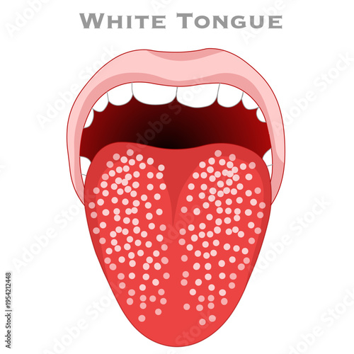 White tongue is when your tongue has patches or spots of white in it. Oral diseases. Illustration vector