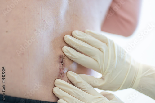 Tableau sur toile Healthcare worker gently examines a healing surgical incision on a patient lower back