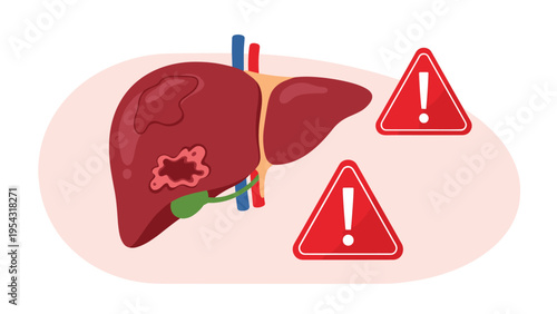 Human liver anatomy with disease damage spots and red exclamation warning signs for health medical diagnosis and awareness concept.
