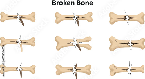 Broken bone fracture types vector illustration showing crack patterns in human skeletal bones with medical injury classification and orthopedic diagram set