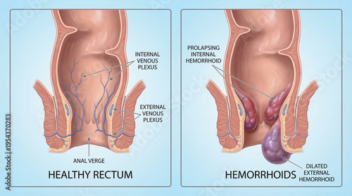 3D Medical Diagram of Healthy Rectum vs Internal and External Hemorrhoids
