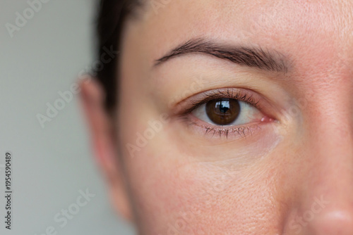 Billede på lærred Close-up shot of young woman with a swollen face and eyes, showing signs of fluid retention from poor sleep or health issues
