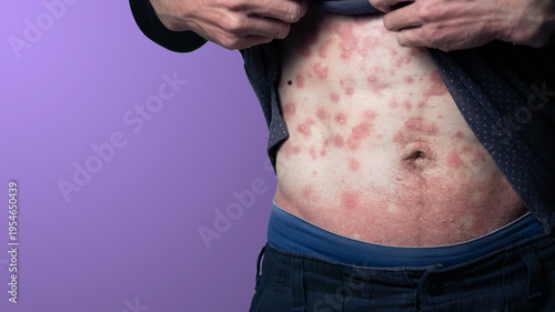 Itchy rash on abdominal
