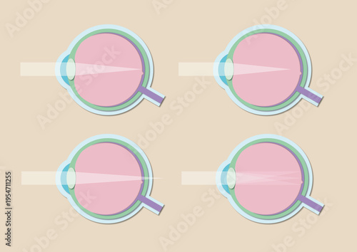 Vision disorders, illustration