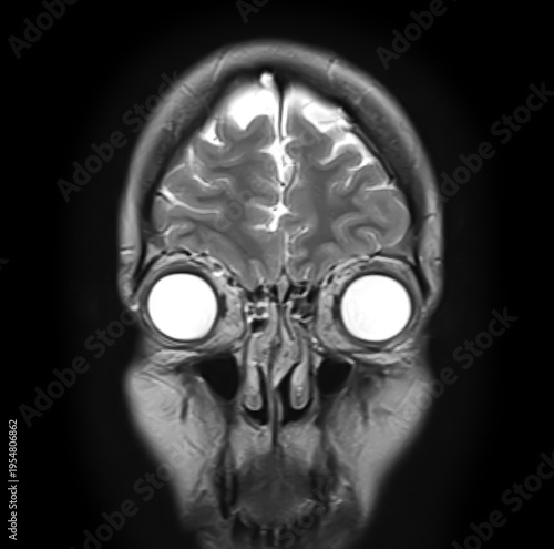 Normal brain MRI, coronal T2-weighted image showing frontal lobes, cerebral cortex, interhemispheric fissure, orbits, globes, ethmoid sinuses and nasal cavity.