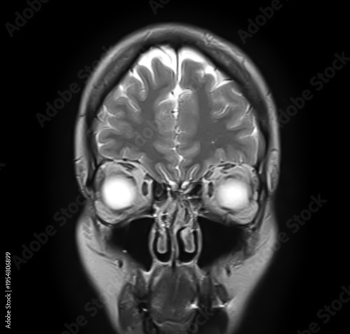 Normal brain MRI, coronal T2-weighted image showing frontal lobes, cerebral cortex, interhemispheric fissure, orbits, globes, ethmoid air cells, maxillary sinuses and nasal cavity.
