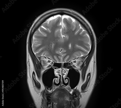 Normal brain MRI, coronal T2-weighted image showing frontal lobes, cerebral cortex, interhemispheric fissure, ethmoid air cells, maxillary sinuses, nasal cavity and turbinates.