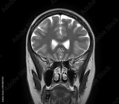 Normal brain MRI, coronal T2-weighted image showing cerebral hemispheres, cortex, lateral ventricles, ethmoid air cells, maxillary sinuses, nasal cavity and turbinates.