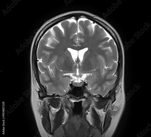 Normal brain MRI, coronal T2-weighted image showing cerebral hemispheres, cortex, lateral ventricles, basal ganglia, thalami, temporal lobes and sphenoid sinus.