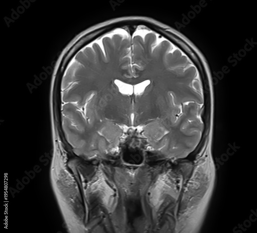 Normal brain MRI, coronal T2-weighted image showing cerebral hemispheres, cortex, lateral ventricles, basal ganglia, thalami, temporal lobes and sphenoid sinus.