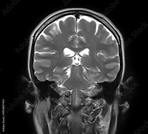 Normal brain MRI, coronal T2-weighted image showing cerebral hemispheres, cortex, lateral ventricles, mesial temporal lobes, hippocampi, brainstem and cerebellum.