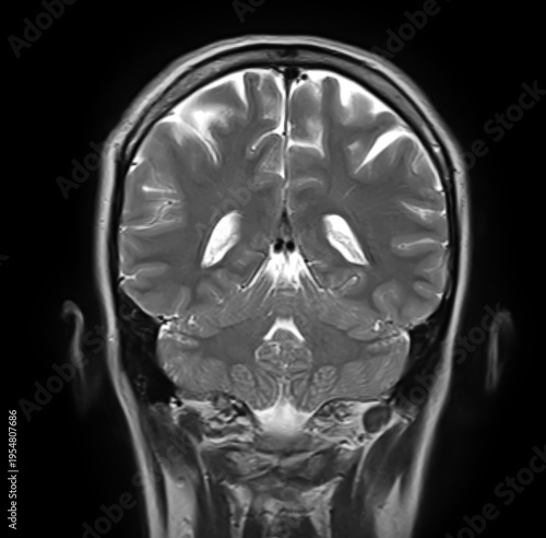 Normal brain MRI, coronal T2-weighted image showing cerebral hemispheres, lateral ventricles, cerebellum, cerebellar hemispheres, vermis and brainstem.
