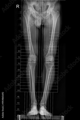 Photography full length standing scanogram of the bilateral lower limbs, captured from the p