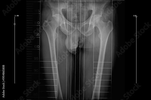 Tableau sur toile full length standing scanogram of the bilateral lower limbs, captured from the p