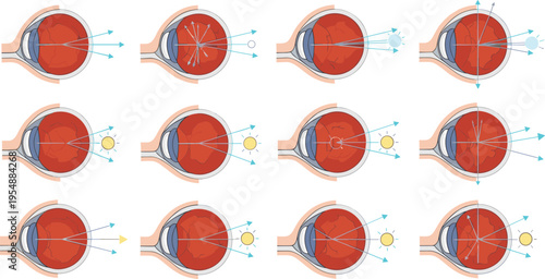 Human Eye Refraction and Vision Conditions Set Showing Light Focus, Near and Far Sightedness, and Retinal Image Formation