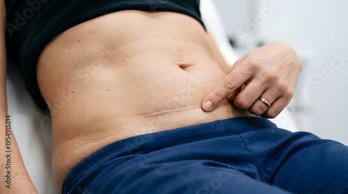 close-up of abdominal surgical scar with woman pointing medical recovery concept