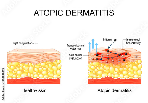 Atopic dermatitis. Atopic eczema.