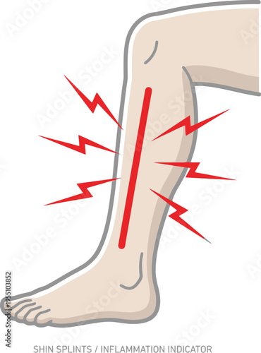 Shin splints inflammation indicator, leg pain, muscle strain graphic illustration