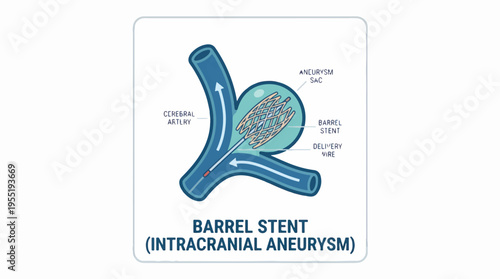 Illustration of a barrel stent being deployed to treat an intracranial aneurysm, showing the stent, delivery wire, cerebral artery, and aneurysm sac.