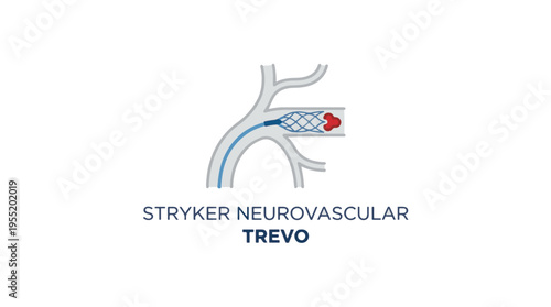 Illustration of the Stryker Trevo retriever device deployed in a blood vessel to remove a blood clot.