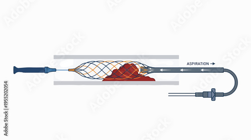 A thrombectomy device with a catheter, basket, and blood clot within a blood vessel, showing aspiration.
