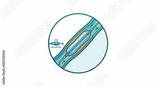 Medical illustration showing a deflated balloon angioplasty catheter being guided into an artery. The balloon inflates to widen the vessel.
