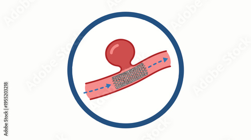 Medical diagram showing an aneurysm in a blood vessel treated with a flow diverter, illustrating blood flow past the device.