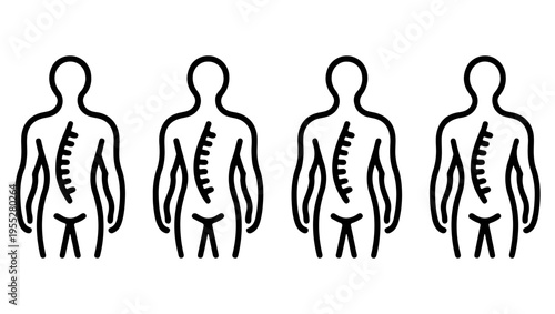 Illustration depicting varying degrees of spinal curvature and postural abnormalities