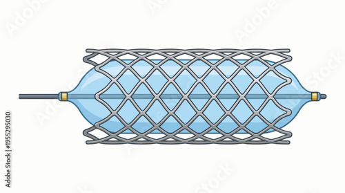 An illustration of a medical stent being expanded by an inflated balloon catheter, a common device used in angioplasty to open blocked blood vessels.