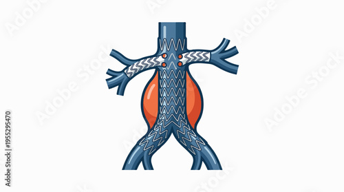Illustration shows an aortic aneurysm being treated with a stent graft. The graft bypasses the bulging section of the aorta.