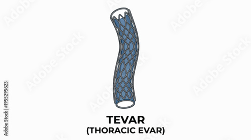 An illustration of a TEVAR (Thoracic EVAR) device, a stent graft used to treat aortic aneurysms in the chest.