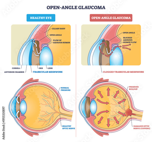 Open-angle glaucoma overview contrasts healthy vs blocked outflow, trabecular meshwork, aqueous humor flow, and optic nerve show pressure buildup concept. Outline diagram