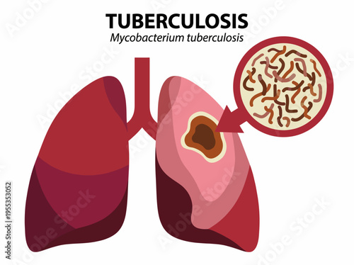 An educational representation of tuberculosis in human lungs, showcasing the disease's impact on health while highlighting the bacteria Mycobacterium tuberculosis.