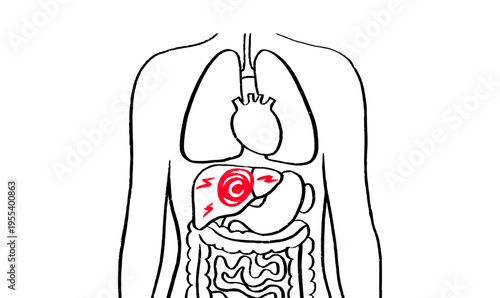 Liver disease concept