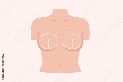 Female Torso with Breast Augmentation Incision Marks - Cosmetic Surgery Diagram