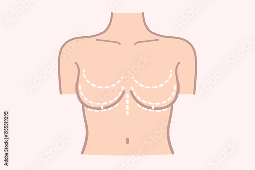 Breast Augmentation or Lift Preoperative Marking Diagram – Medical Surgical Incision Lines Illustration