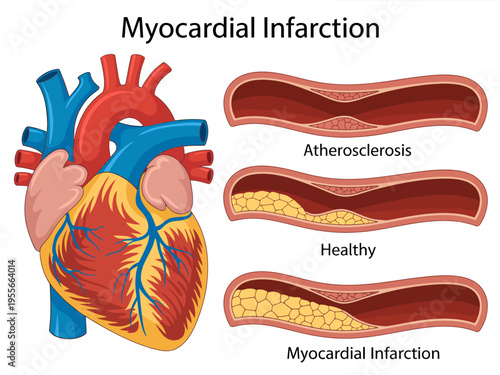 Myocardial Infarction Heart Anatomy and Blood Vessel Cross Sections
