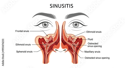 Medical illustration detailing the anatomy and inflamed sinus cavities associated with sinusitis condition