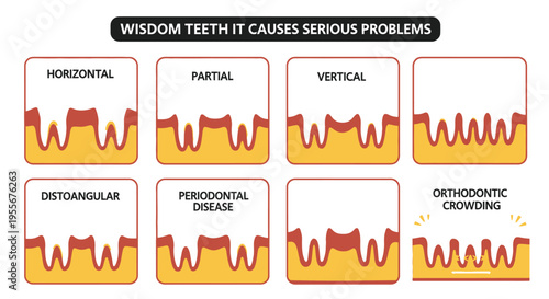 An infographic illustrating different types of wisdom teeth impaction and resulting dental health issues